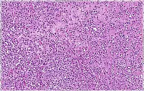 Lobular breast cancer. Single file cells and cell nests.