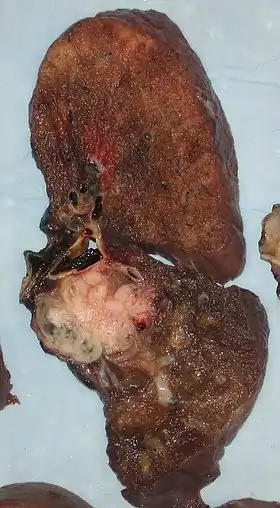 A squamous-cell carcinoma (the whitish tumor) near the bronchi in a lung specimen