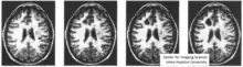 Illustration of changing both gray levels in an imaging which is classical warping from Michael Jackson video as well as diffeomorphic orbit transformation.,