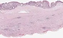 Mucinous cystadenoma of the pancreas