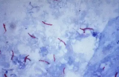 Mycobacterium tuberculosis on Ziehl-Neelsen stain