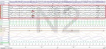 Stage N2 Sleep. EEG highlighted by red box. Sleep spindles highlighted by red line.