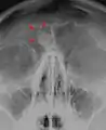 Osteoma of the frontal sinus seen on x-ray