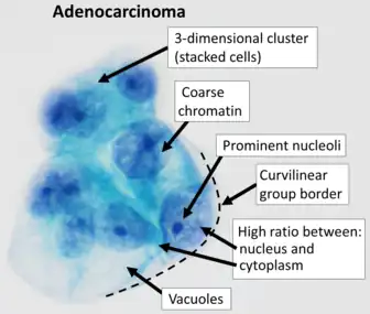 Cytopathology of peritoneal fluid (Pap stain) in a case of peritoneal carcinomatosis, showing typical features of adenocarcinoma.