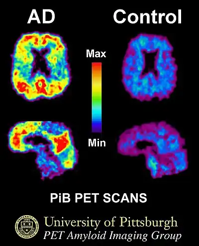 Image showing large areas of red and yellow in the "AD" brain on the left and no apparent red or yellow in the "Control" brain on the right.