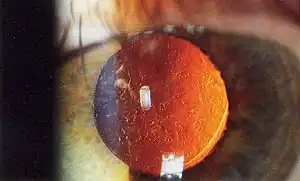 Intraoccular lens in place