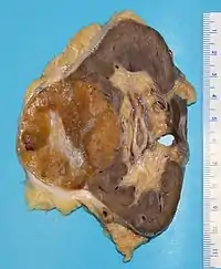 Gross appearance of the cut surface of a nephrectomy specimen containing a renal oncocytoma. Note the rounded contour, the mahogany colour and the central scar.