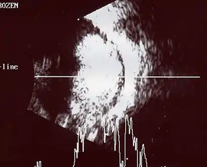 An ocular ultrasound of a large retinoblastoma tumor within the eye of a 3-year-old boy