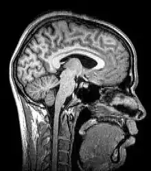 Median plane magnetic resonance imaging of the head.