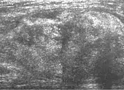 Liposarcoma. A heterogeneous mass consists of an upper hyperechoic portion corresponds to lipomatous matrix and areas of hypoechogenicity corresponds to nonlipomatous component is seen.[citation needed]