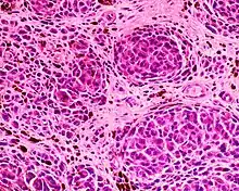 Epithelioid blue nevus