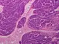 Dermal cylindroma. Puzzle-like distribution of tumour foci.