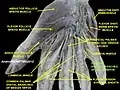 Common palmar digital btanches of ulnar nerves