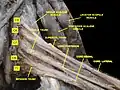 Brachial plexus. Deep dissection.