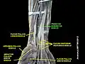 Pronator quadratus muscle