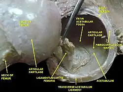 Hip joint. Lateral view. Transverse acetabular ligament