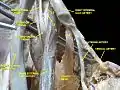 Lumbosacral plexus Deep dissection.