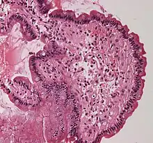 Small bowel duodenum with amyloid deposition 20X