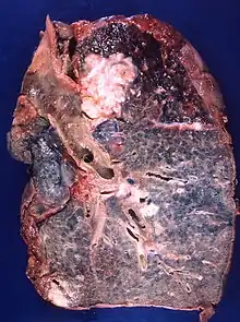 A squamous-cell lung carcinoma developing in the bronchius