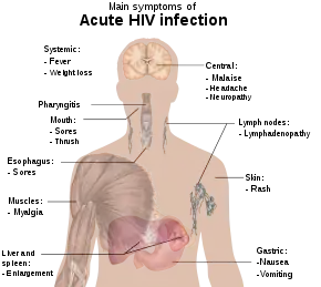 A diagram of a human torso labeled with the most common symptoms of an acute HIV infection