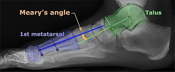 Same lateral X-ray showing the measurement of Meary's angle, which is the angle between the long axis of the talus and first metatarsal bone. An angle greater than 4° convex downward is considered a flat foot, 15° - 30° moderate flat foot, and greater than 30° severe flat foot.