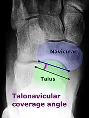 Dorsoplantar projectional radiograph of the foot showing the measurement of the talonavicular coverage angle.