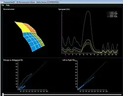 Thoracic Patient SLP Scan