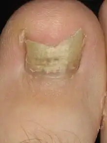 Onychomycosis