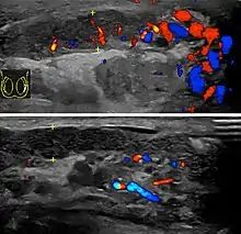 Doppler ultrasound of epididymitis, seen as a substantial increase in blood flow in the left epididymis (top image), while it is normal in the right (bottom image). The thickness of the epididymis (between yellow crosses) is only slightly increased (7 mm).