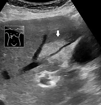 Abdominal ultrasonography of focal steatosis. It is distinguished from a tumor by not compressing the hepatic vein.