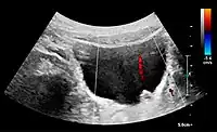 Figure 21. Left hydroureter with ureteric jet. No stone is visible. The red color in the color box represents motion towards the transducer as defined by the color bar.