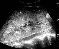 Figure 27. Postoperative renal failure with increased cortical echogenicity and kidney size. Biopsy showed acute tubular necrosis.