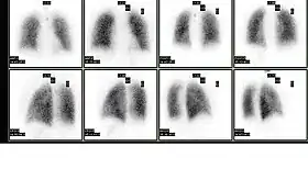 Normal pulmonary ventilation and perfusion (V/Q) scan. The nuclear medicine V/Q scan is useful in the evaluation of pulmonary embolism.