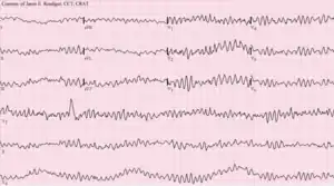 Electrocardiographic image depicting Ventricular fibrillation