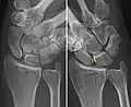 Dynamic instability: Increased scapholunate distance (between yellow lines) upon ulnar deviation of the wrist, but not otherwise.