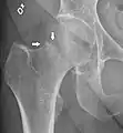 X-ray showing a suspected compressive subcapital fracture as a radiodense line